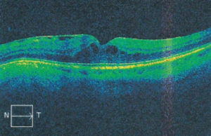 Ryc. 3. OCT lewego oka – cukrzycowy obrzęk plamki (grubość siatkówki w centrum wynosi 429 µm), w pęczku tarczowo-plamkowym widoczna błona nasiatkówkowa.