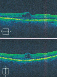 Ryc. 5. OCT prawego oka – DME, stan przed iniekcją doszklistkową leku anty-VEGF (grubość siatkówki w centrum wynosi 325 µm).