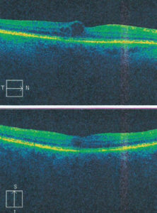 Ryc. 6. OCT prawego oka – DME, 7 dni po doszklistkowym podaniu leku anty-VEGF (grubość siatkówki w centrum wynosi 307 µm).