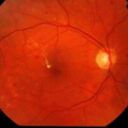 Cukrzycowy obrzęk plamki (DME)