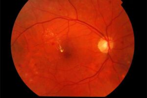 Cukrzycowy obrzęk plamki (DME)